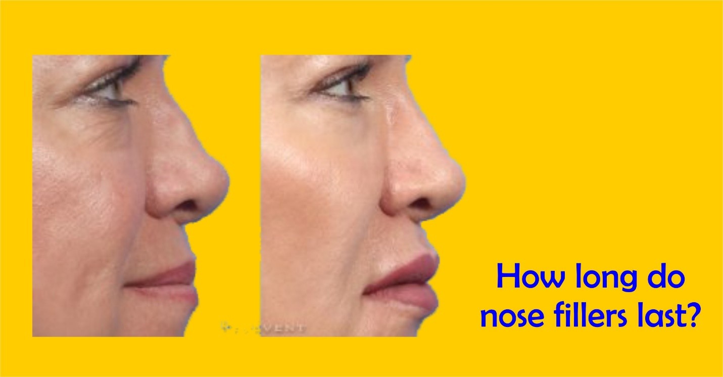 How long do nose fillers last