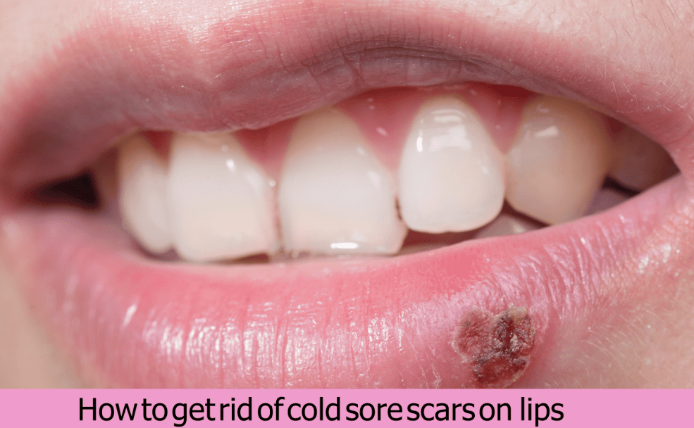 How to get rid of cold sore scars